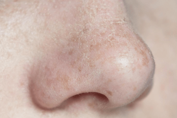 How To Get Rid Of Dry Skin On Nose