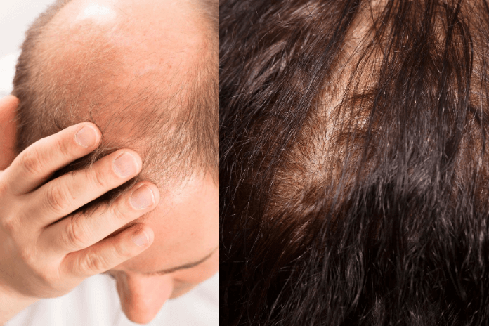 How To Grow Hair On Bald Spots Naturally