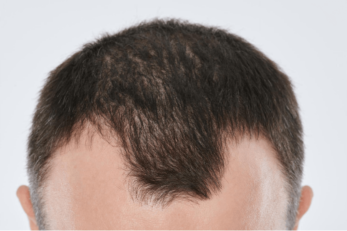 Growing hair on bald spots naturally