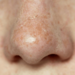 5 Effective Steps Of How To Get Rid Of Dry Skin On Nose: With Causes & Treatment How To Get Rid Of Dry Skin On Nose