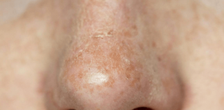 5 Effective Steps Of How To Get Rid Of Dry Skin On Nose: With Causes & Treatment How To Get Rid Of Dry Skin On Nose