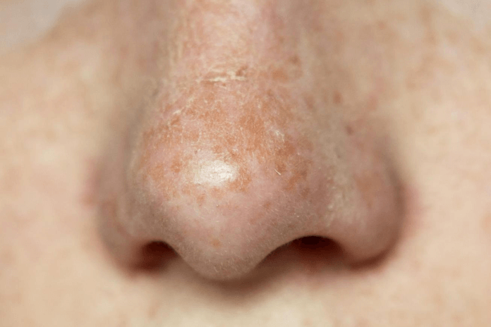 How To Get Rid Of Dry Skin On Nose