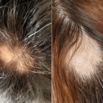 10 Tips & Tricks Of How To Grow Hair On Bald Spots Naturally How To Grow Hair On Bald Spots Naturally