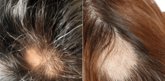 10 Tips & Tricks Of How To Grow Hair On Bald Spots Naturally How To Grow Hair On Bald Spots Naturally