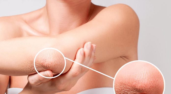 8 Explanation On Why Is My Skin So Dry? Is Important Why Is My Skin So Dry