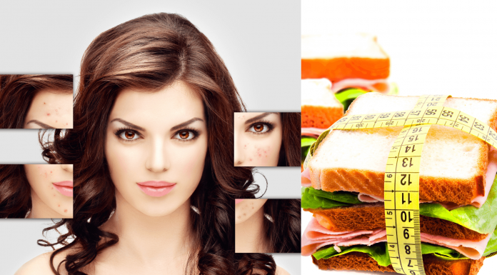 How Diet Affects Acne – Does the right diet help? How Diet Affects Acne