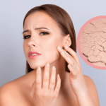 A Complete Guide On How To Deal With Dry Skin How To Deal With Dry Skin