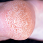 How To Get Rid Of Dry Skin On Feet: 6 Ways And Prevention How To Get Rid Of Dry Skin On Feet