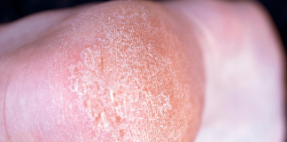 How To Get Rid Of Dry Skin On Feet: 6 Ways And Prevention How To Get Rid Of Dry Skin On Feet