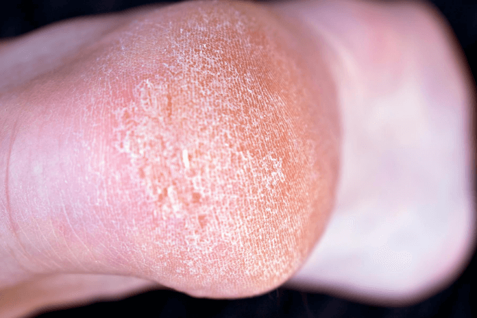 How To Get Rid Of Dry Skin On Feet