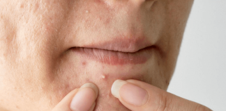 How To Get Rid Of Pimples Naturally How To Get Rid Of Pimples Naturally