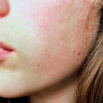 Top 8 Remedies of How To Fix Your Dry Skin How To Fix Dry Skin