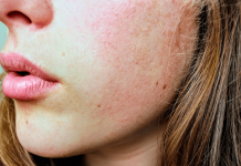 Top 8 Remedies of How To Fix Your Dry Skin How To Fix Dry Skin