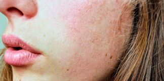 Top 8 Remedies of How To Fix Your Dry Skin How To Fix Dry Skin